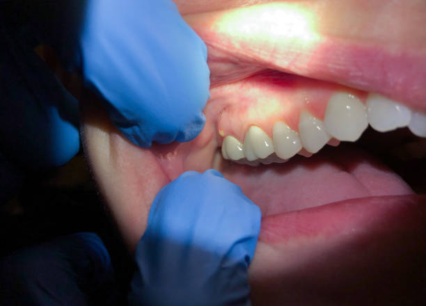 Best Emergency Care for Gum Disease in Llano Grande, TX