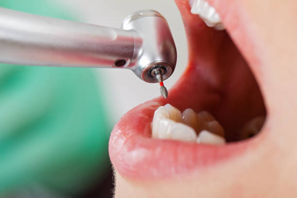 Best Broken or Chipped Tooth Repair in Llano Grande, TX